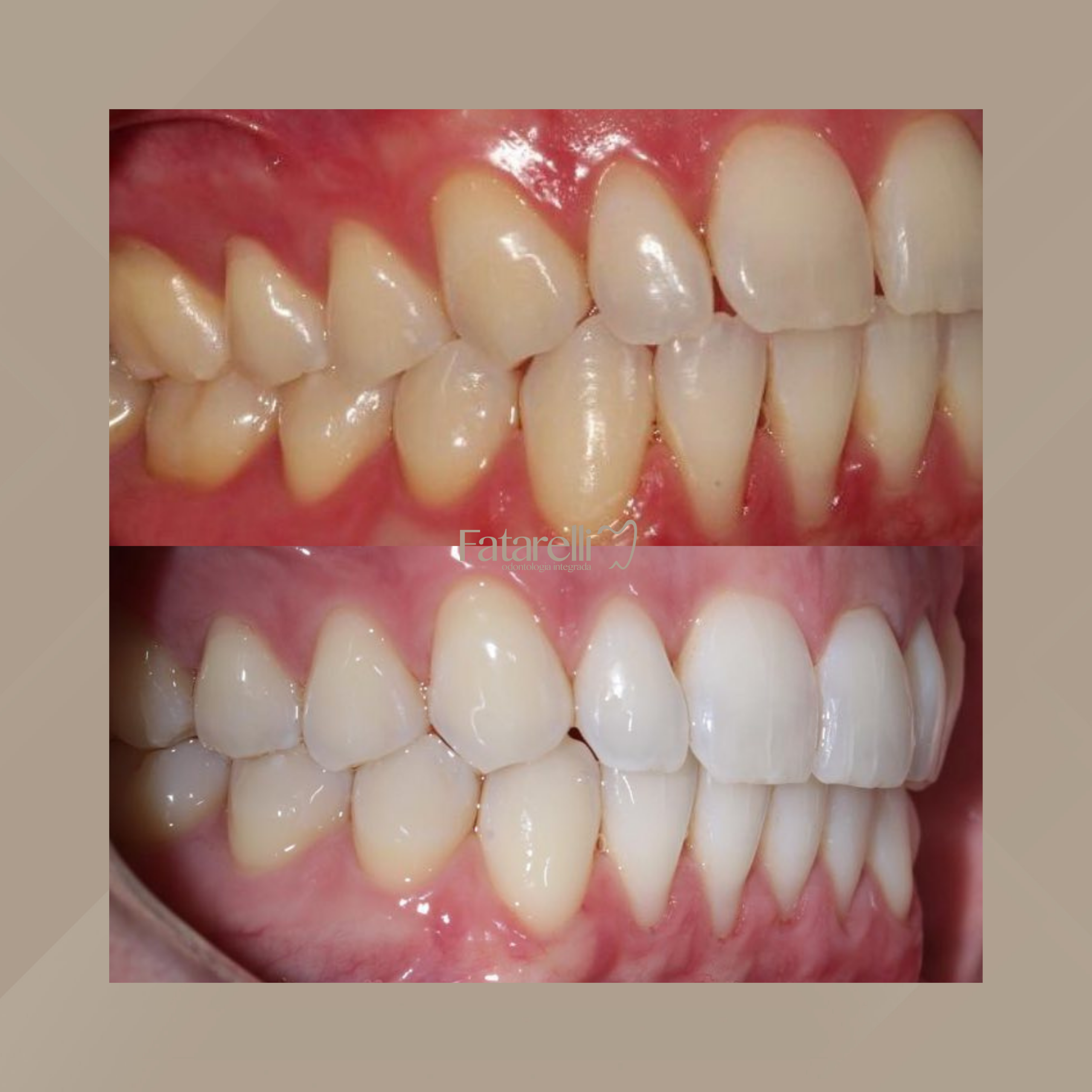 Fatarelli Odontologia Integrada. Clareamento Dental #2.1