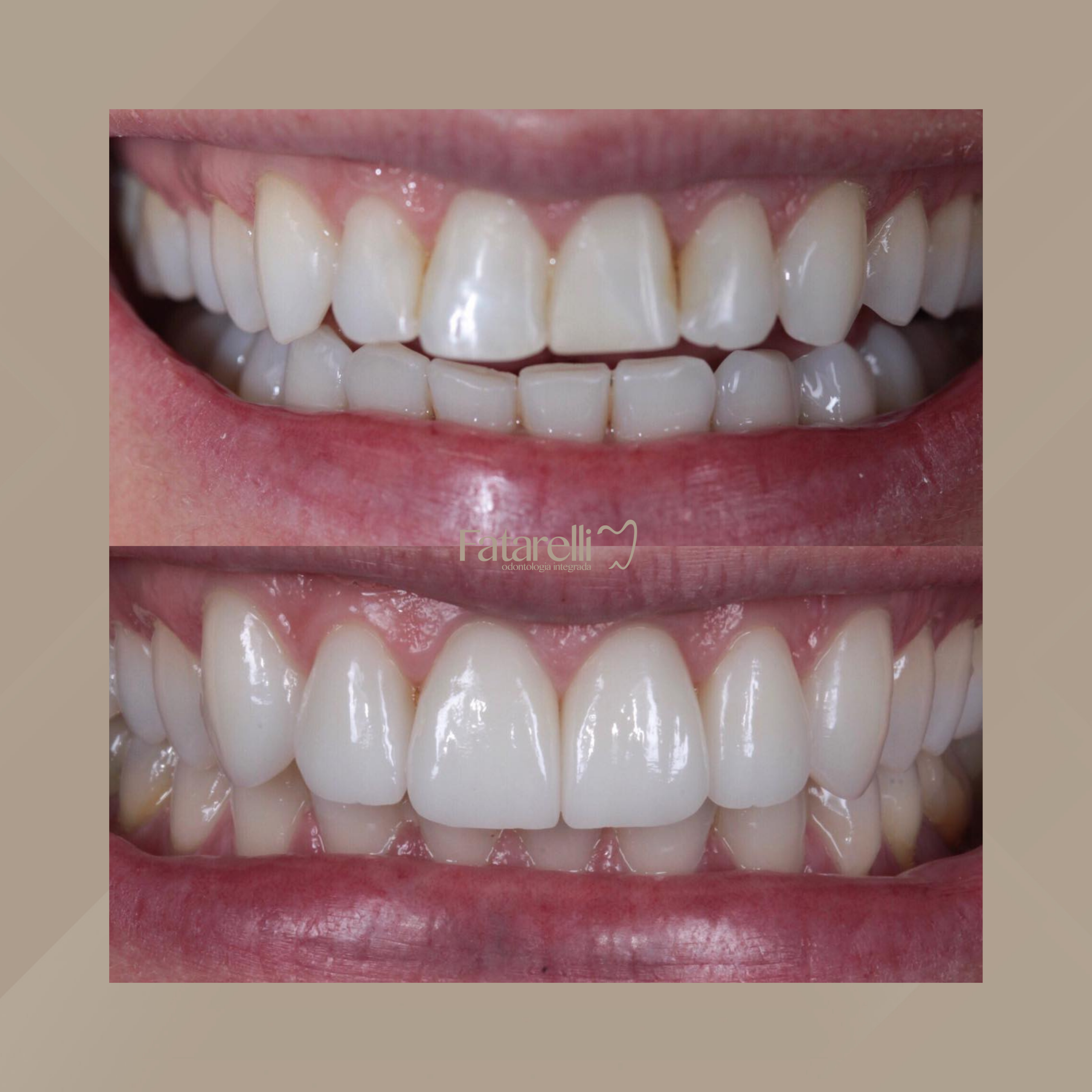 Fatarelli Odontologia Integrada. Facetas Dentárias #1.1