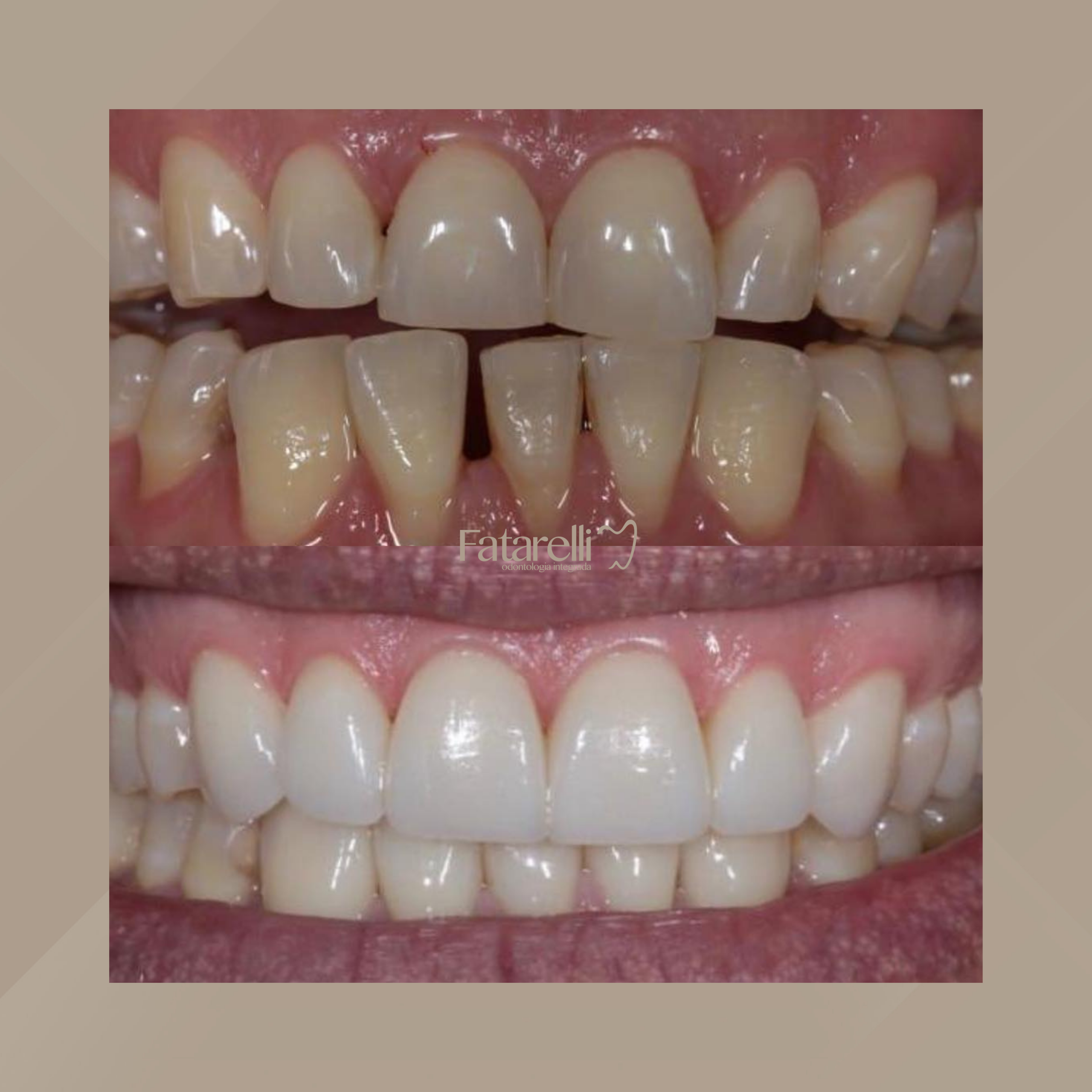 Fatarelli Odontologia Integrada. Facetas Dentárias #2.1