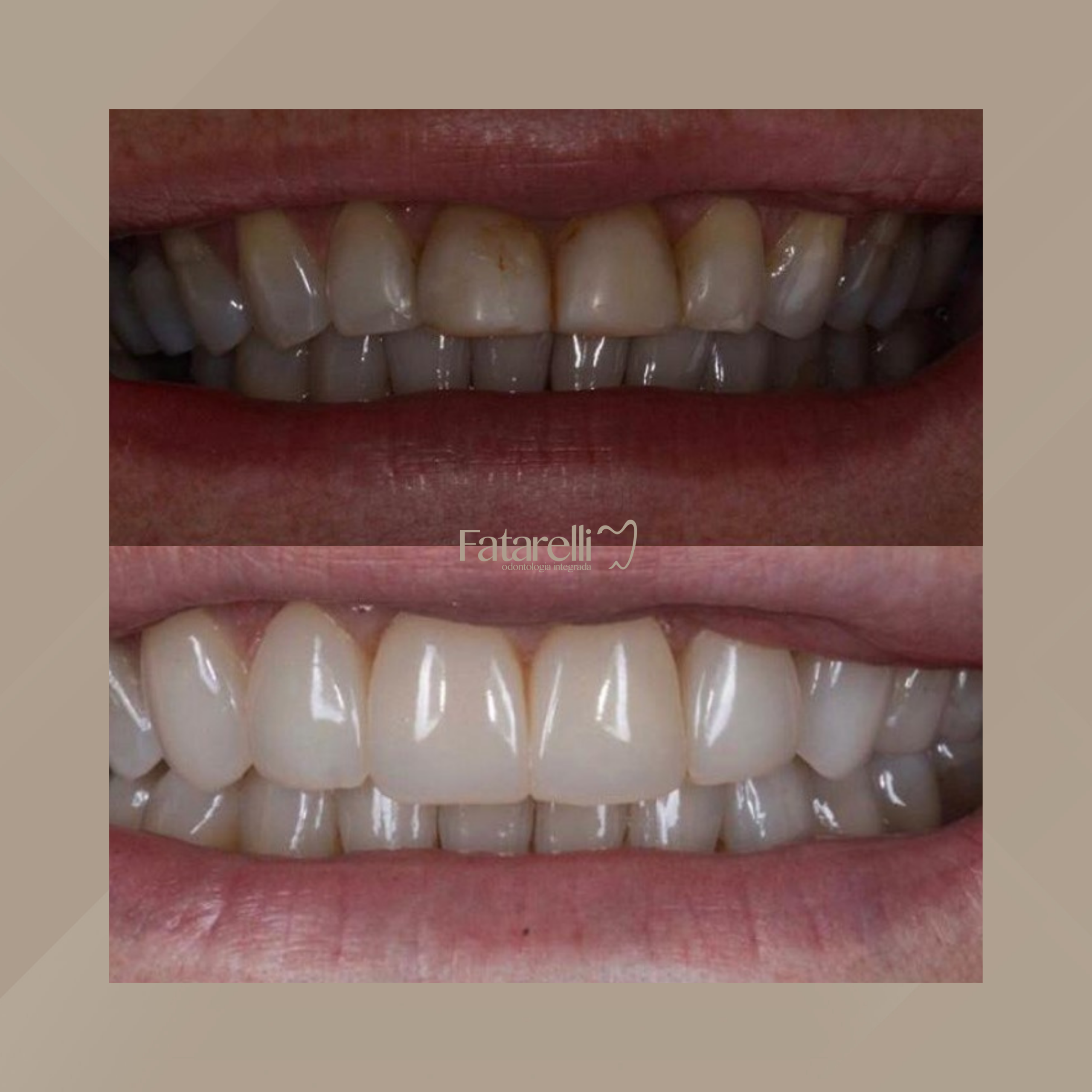 Fatarelli Odontologia Integrada. Facetas Dentárias #3.1