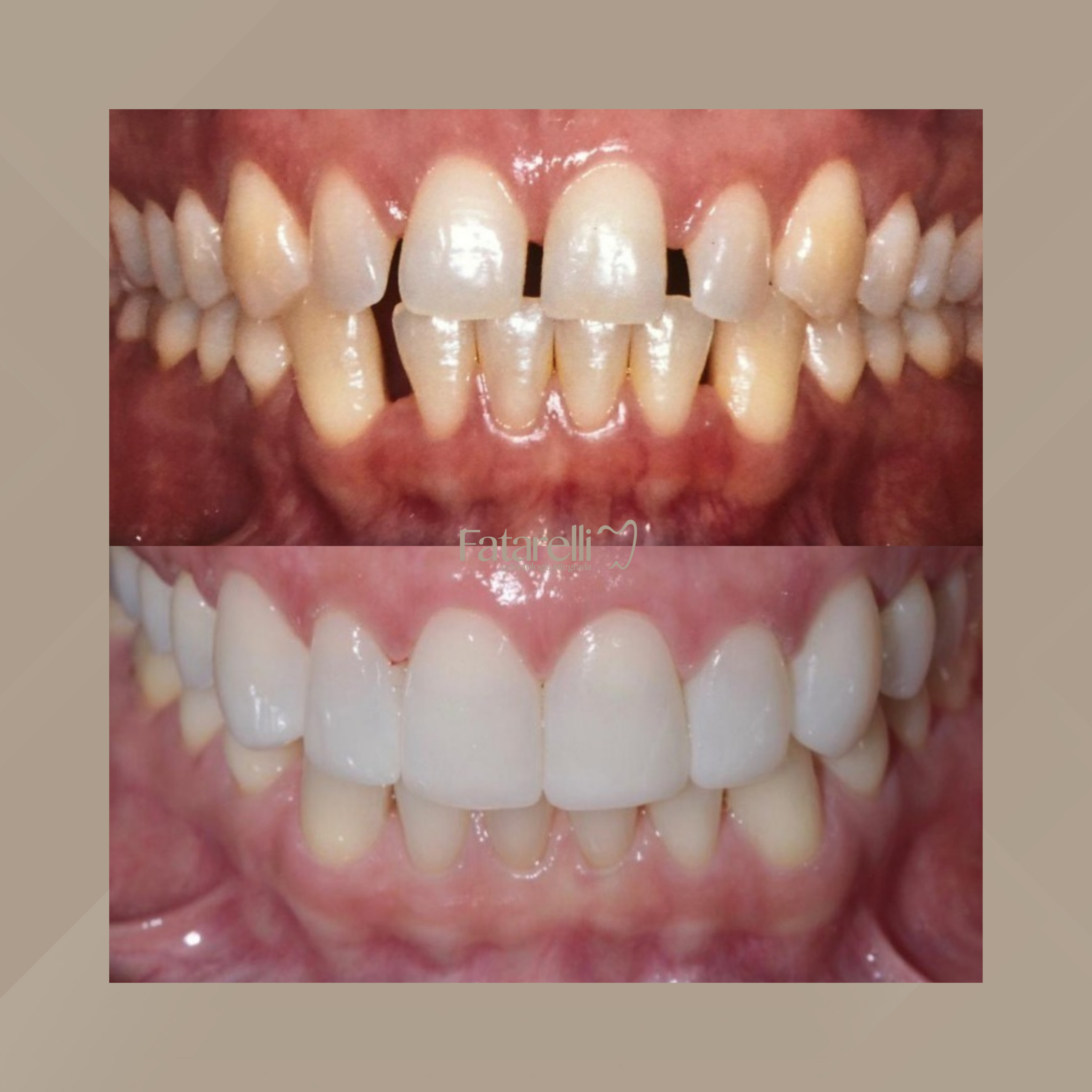 Fatarelli Odontologia Integrada. Facetas Dentárias #4.1