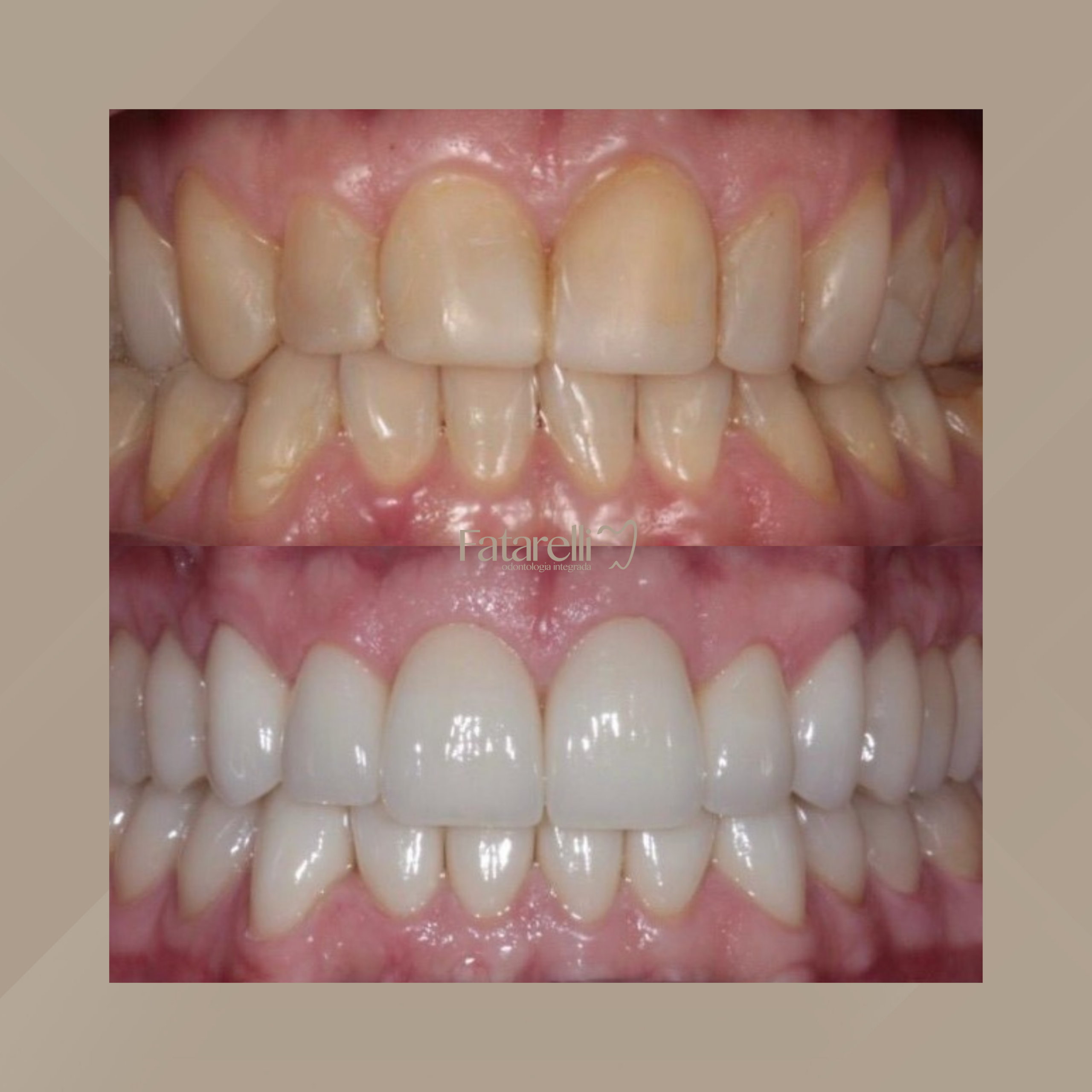 Fatarelli Odontologia Integrada. Facetas Dentárias #5.1