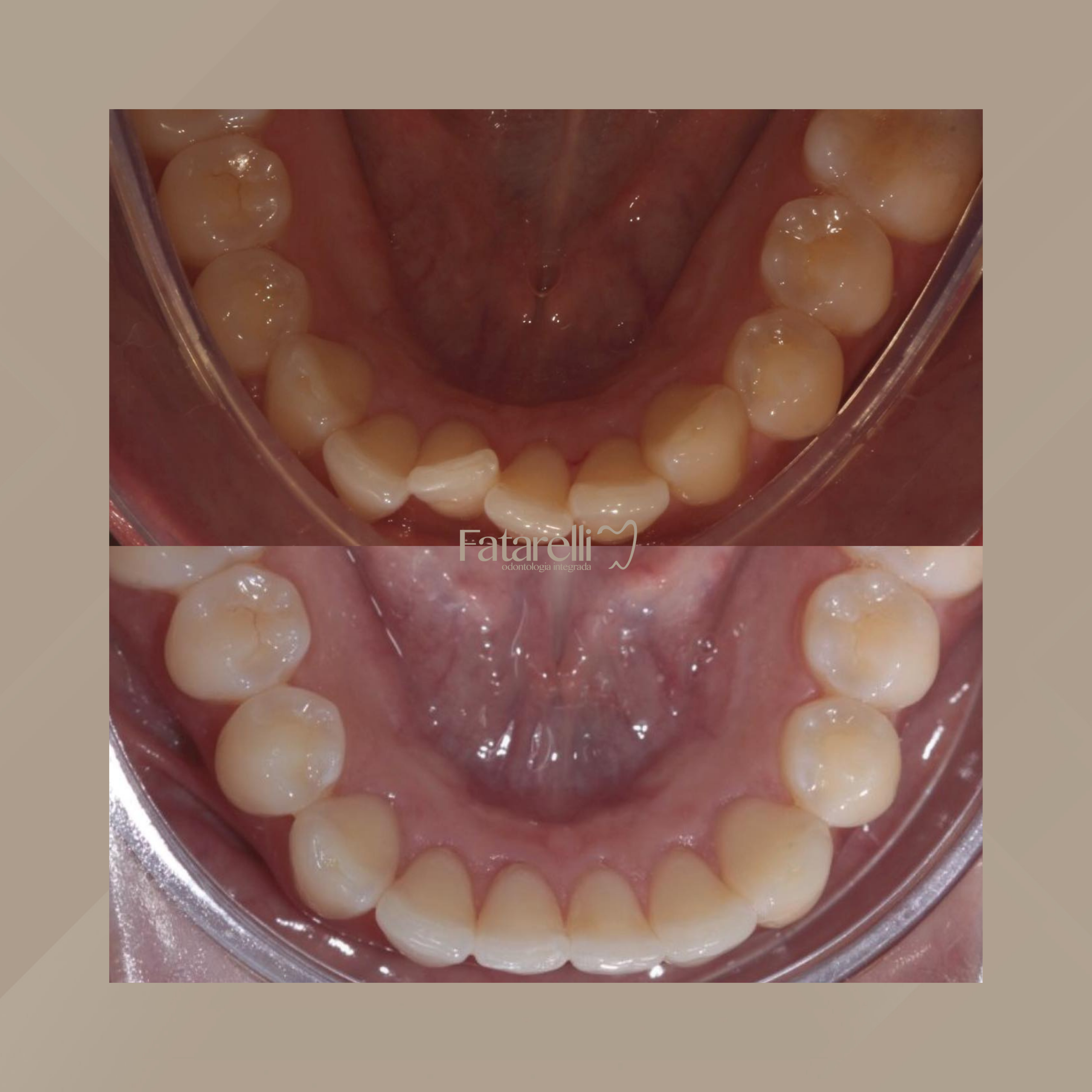 Fatarelli Odontologia Integrada. Invisalign #1.1