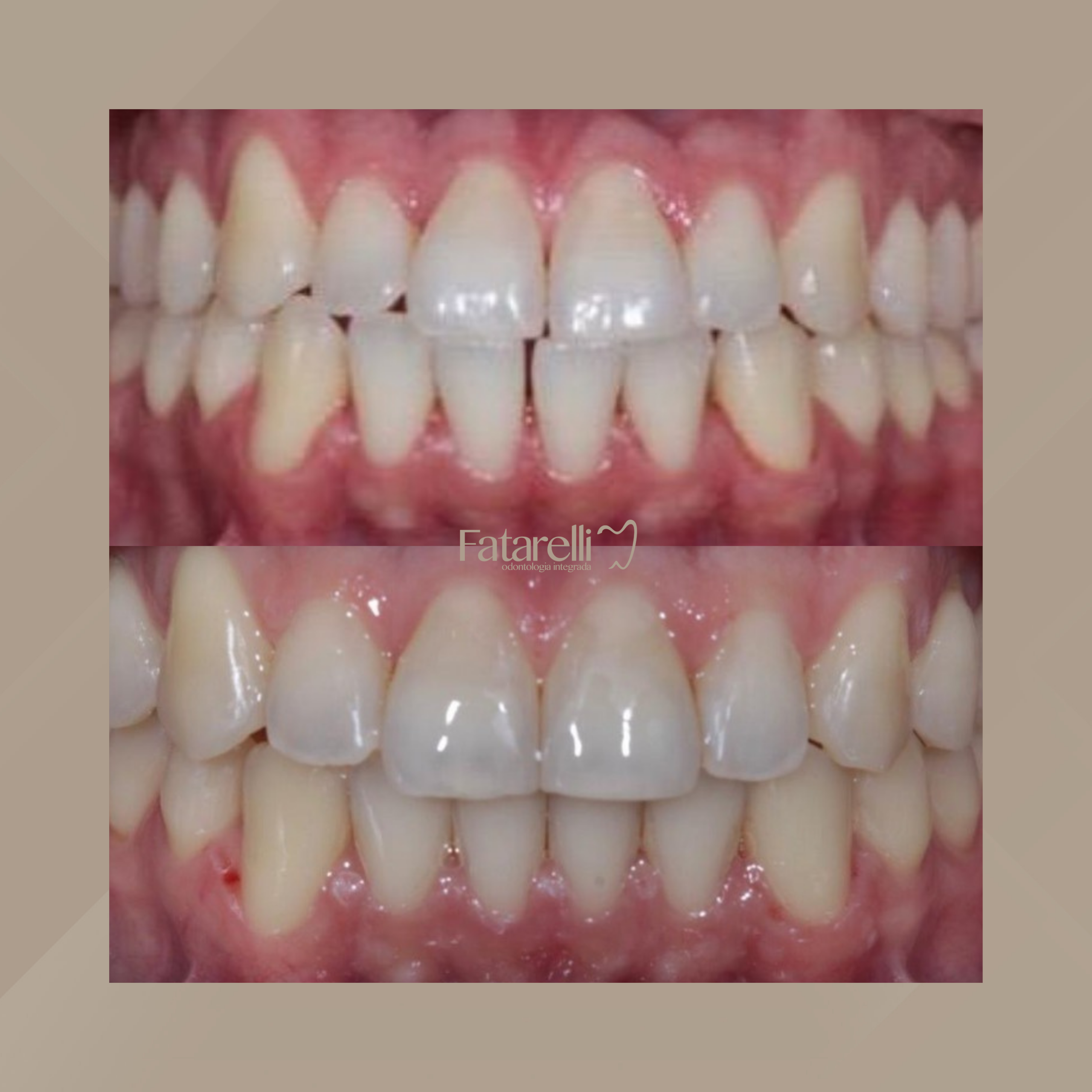 Fatarelli Odontologia Integrada. Invisalign #10.1
