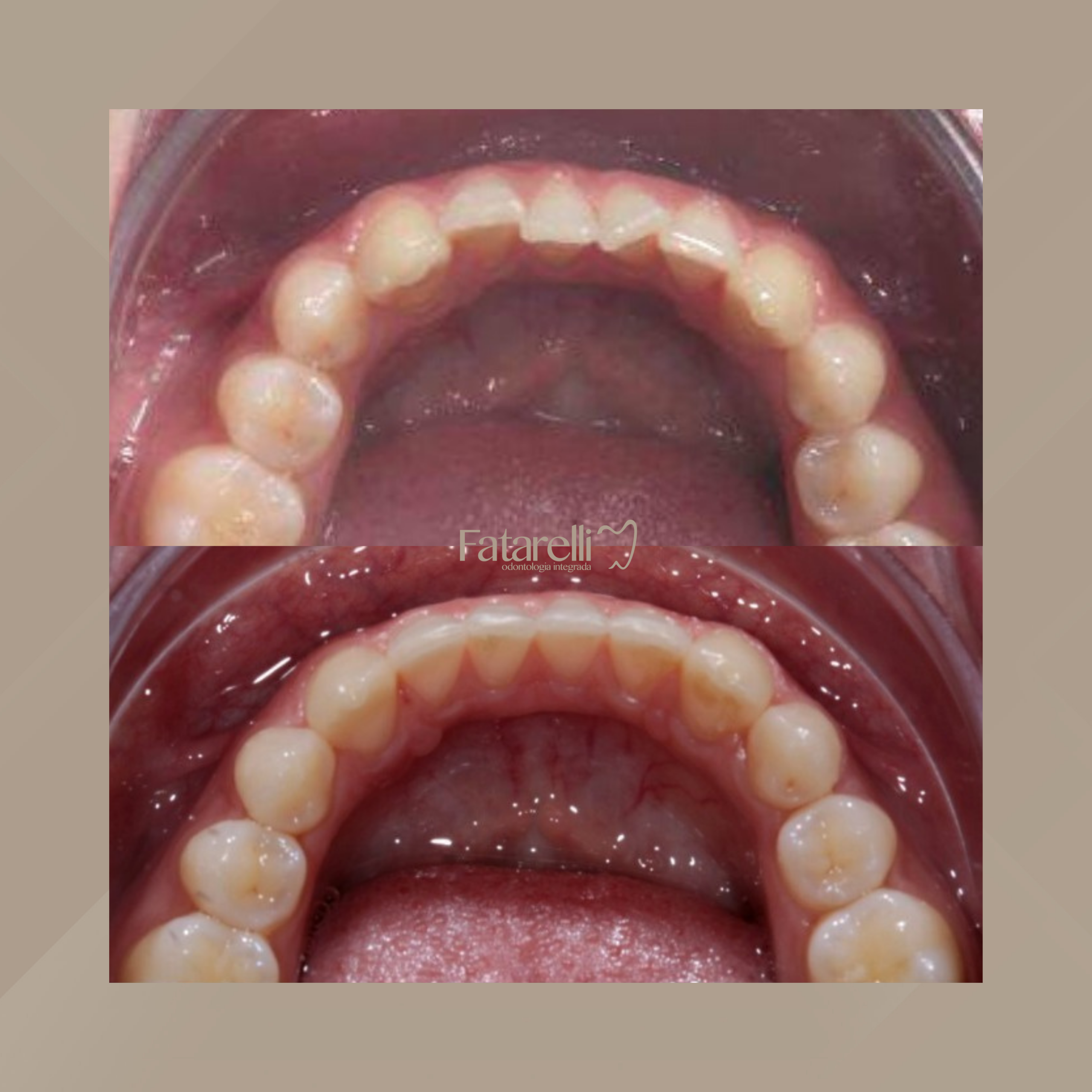Fatarelli Odontologia Integrada. Invisalign #11.1