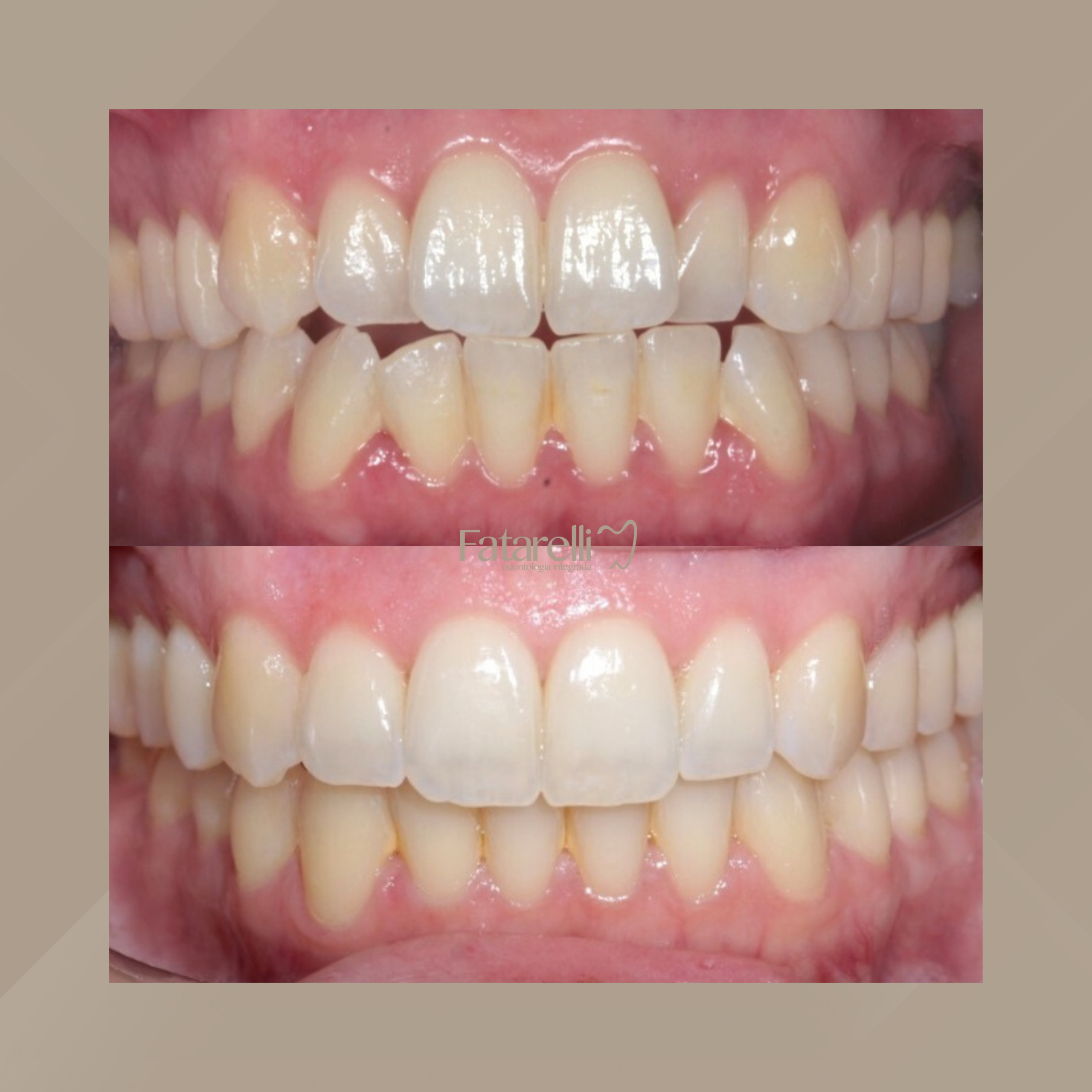 Fatarelli Odontologia Integrada. Invisalign #12.1