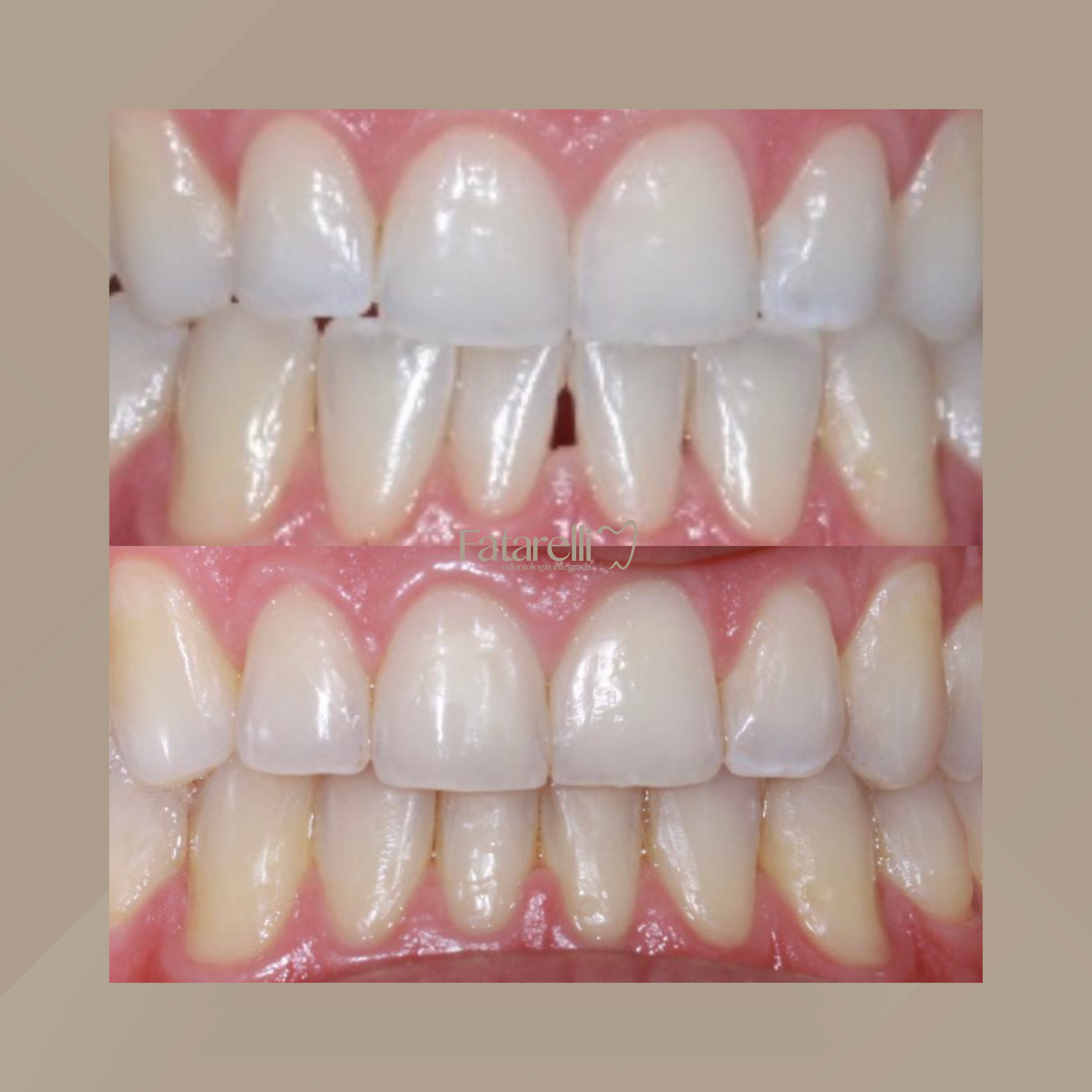 Fatarelli Odontologia Integrada. Invisalign #13.1