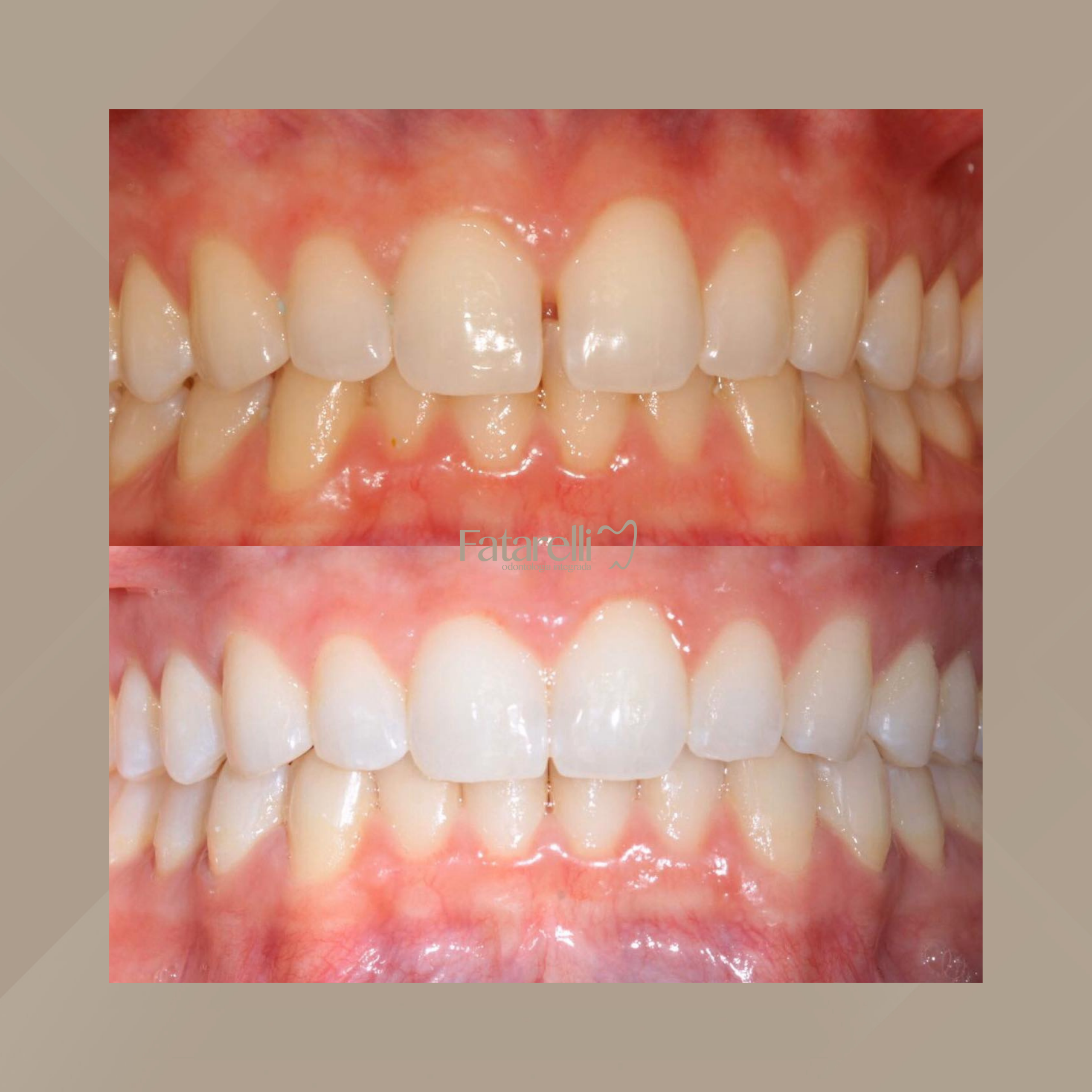 Fatarelli Odontologia Integrada. Invisalign #2.1
