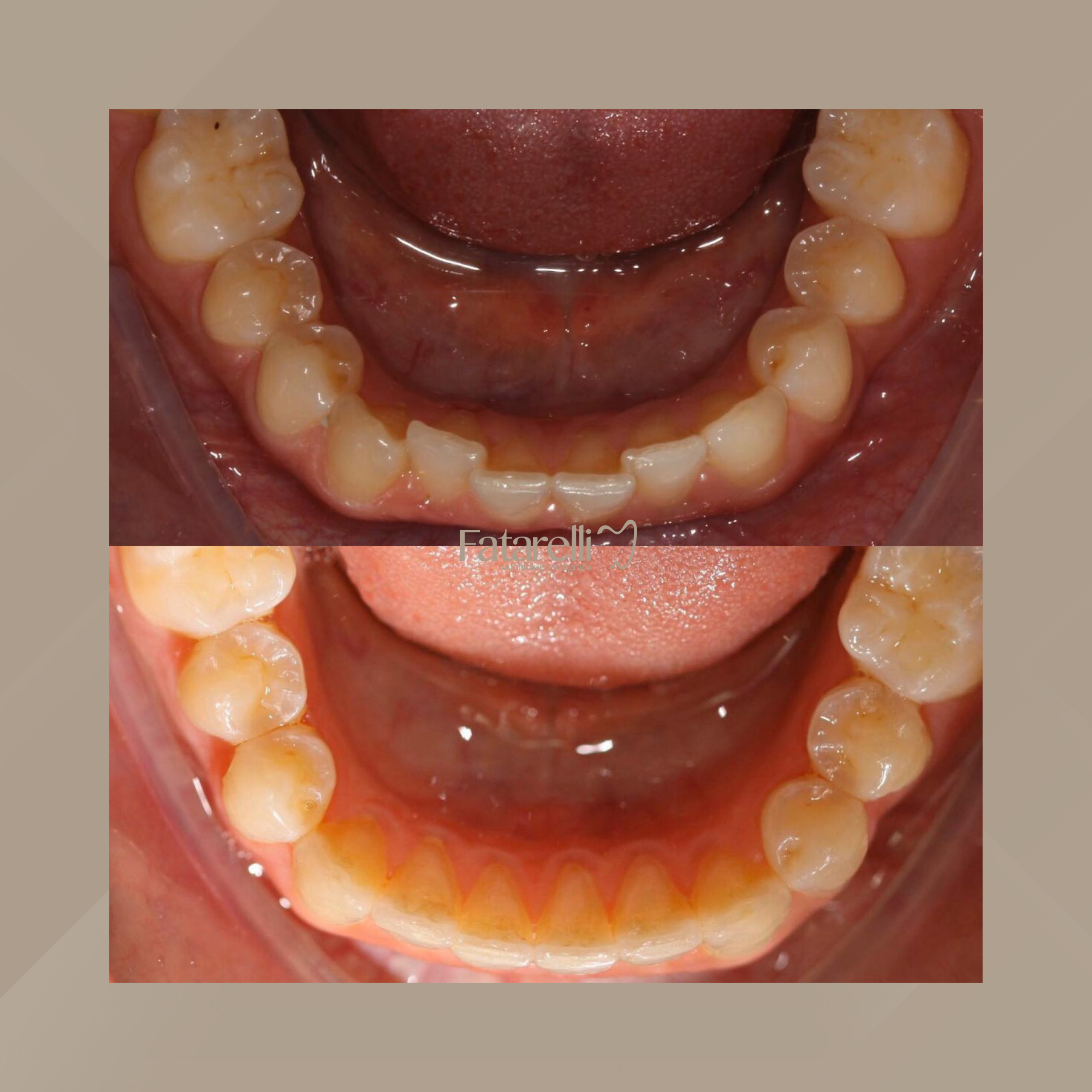 Fatarelli Odontologia Integrada. Invisalign #3.1