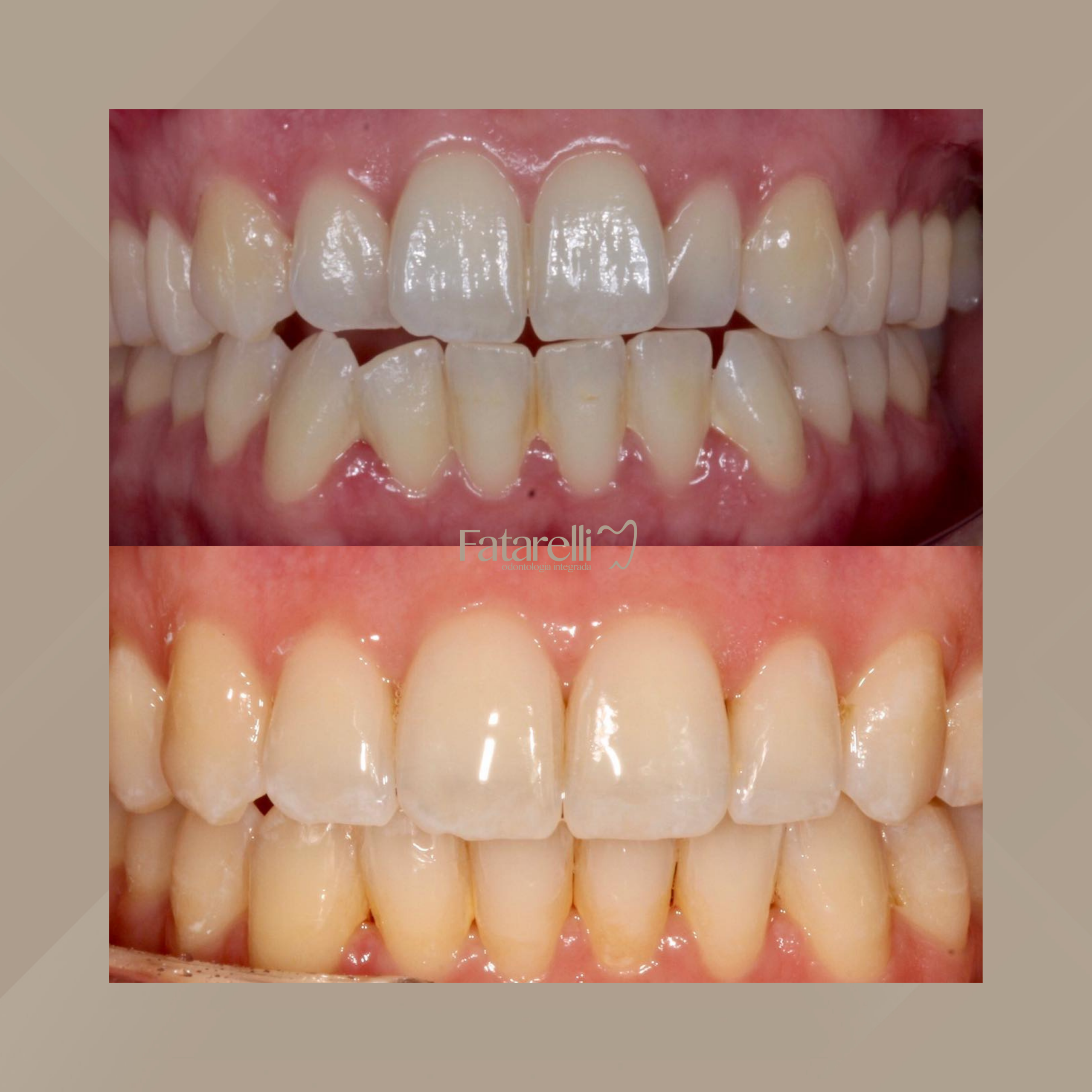 Fatarelli Odontologia Integrada. Invisalign #4.1