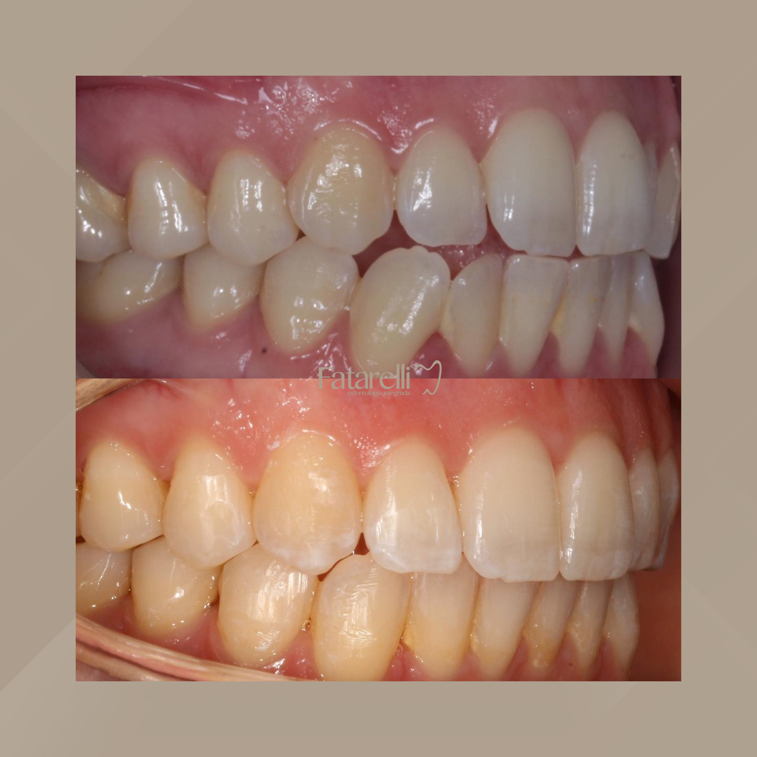 Fatarelli Odontologia Integrada. Invisalign #5.1