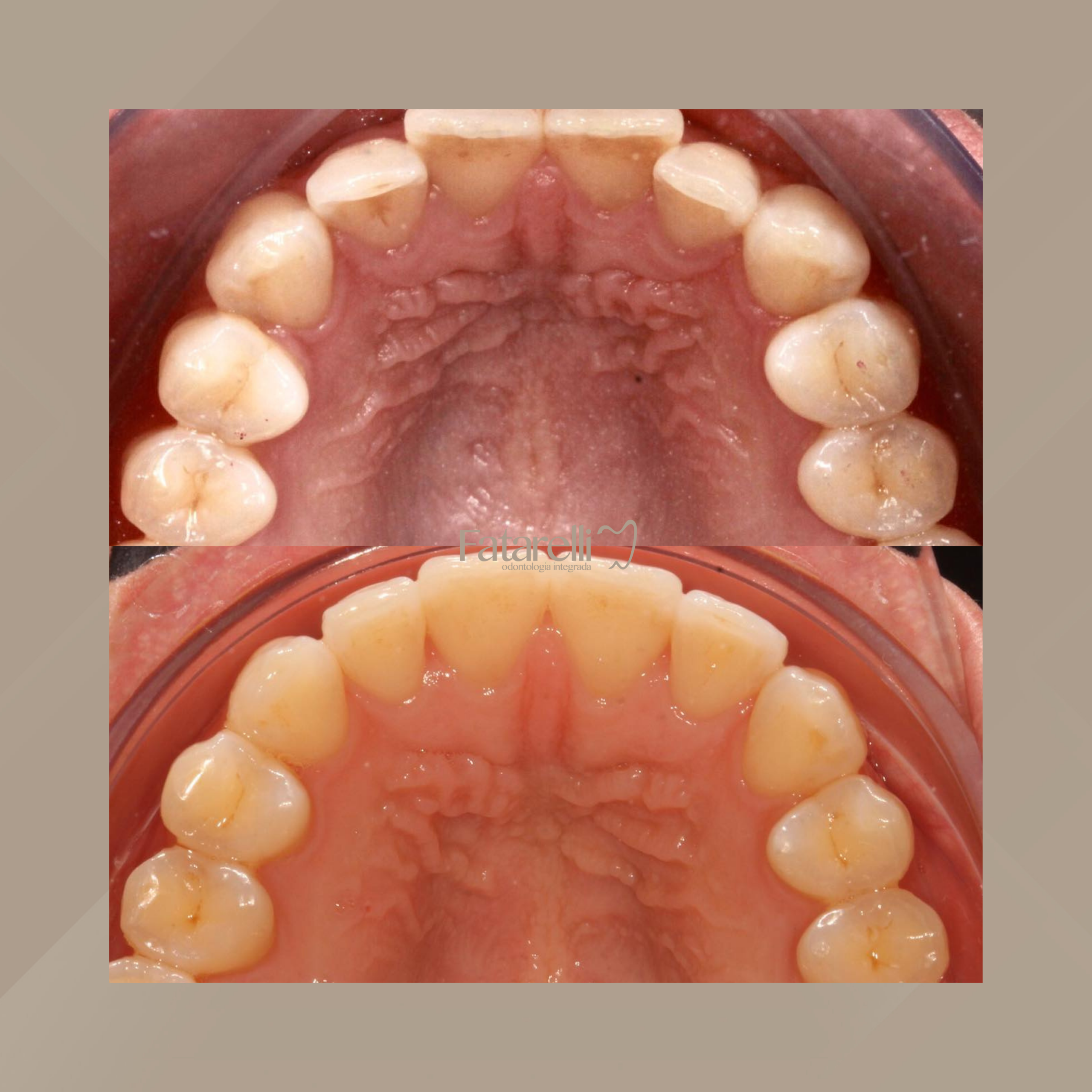 Fatarelli Odontologia Integrada. Invisalign #6.1