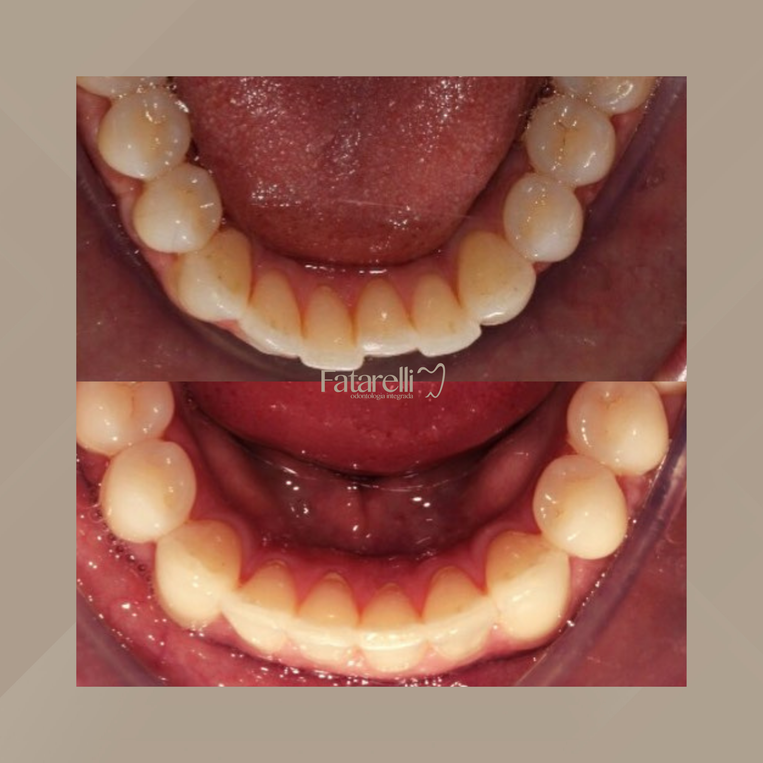 Fatarelli Odontologia Integrada. Invisalign #7.1