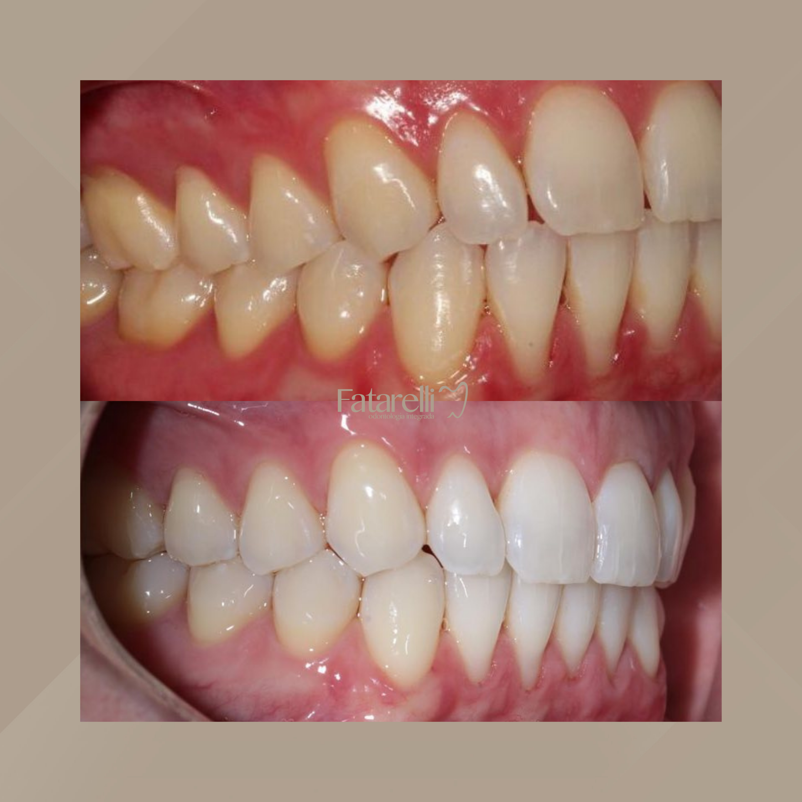 Fatarelli Odontologia Integrada. Invisalign #8.1