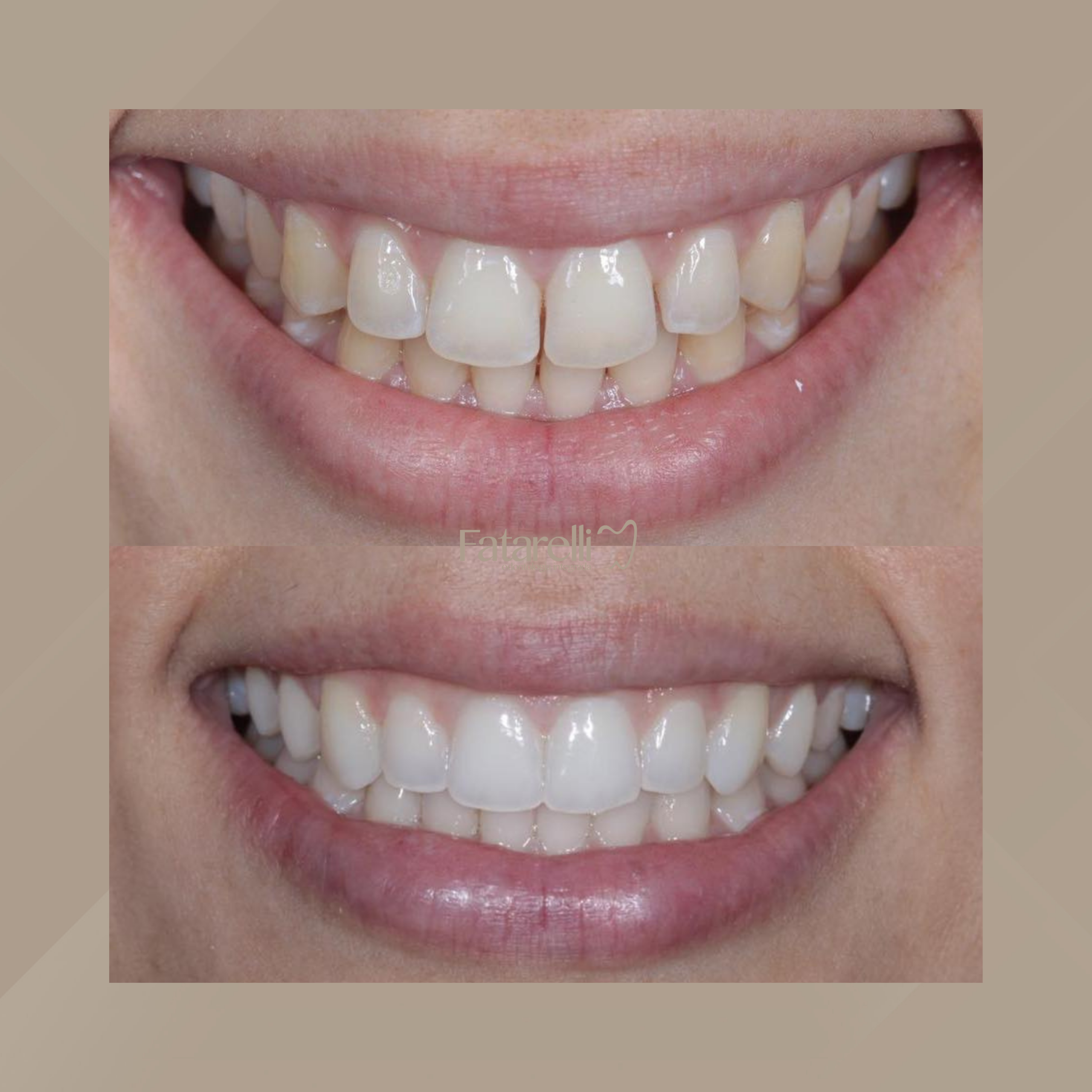 Fatarelli Odontologia Integrada. Invisalign #9.1