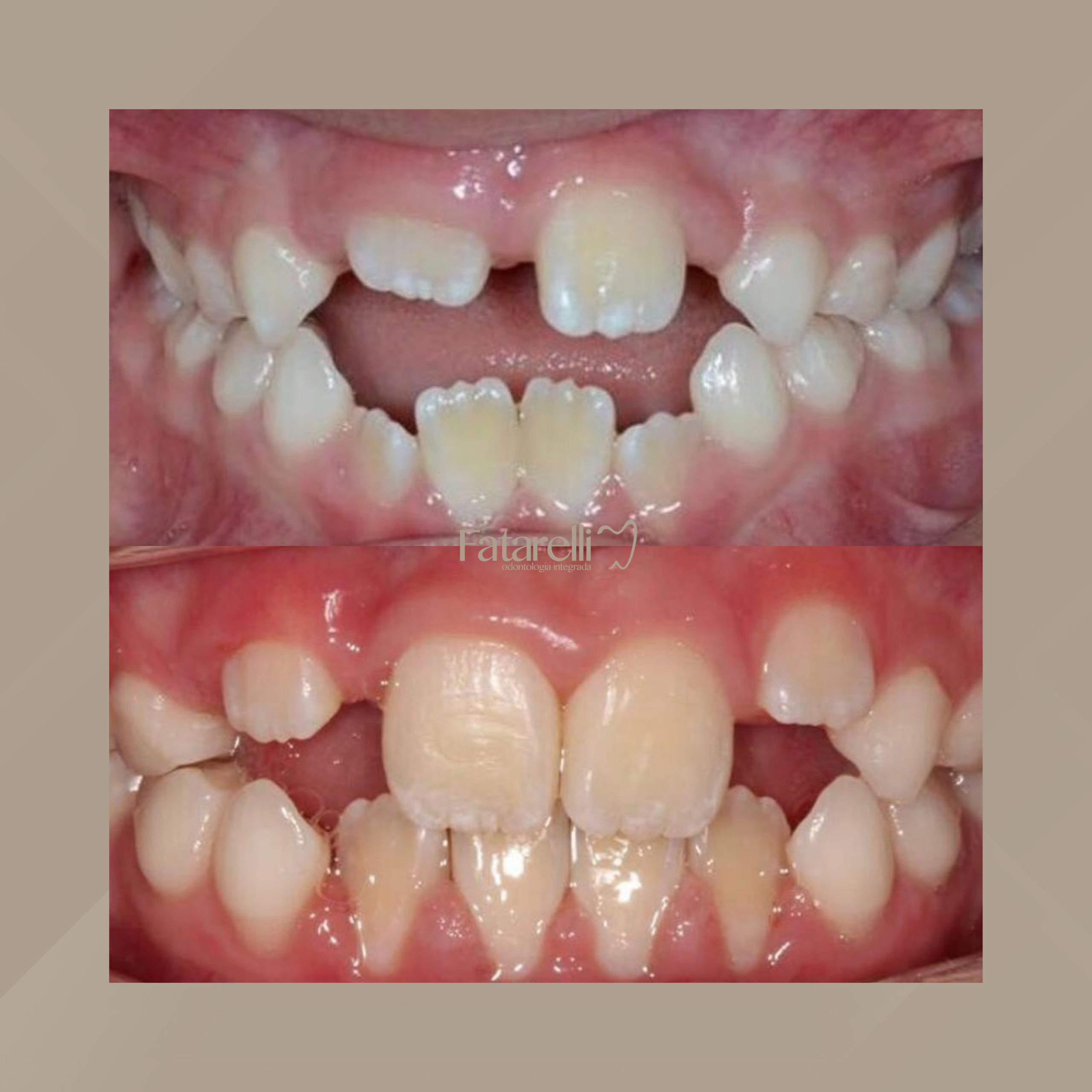 Fatarelli Odontologia Integrada. Odontopediatria #1.1