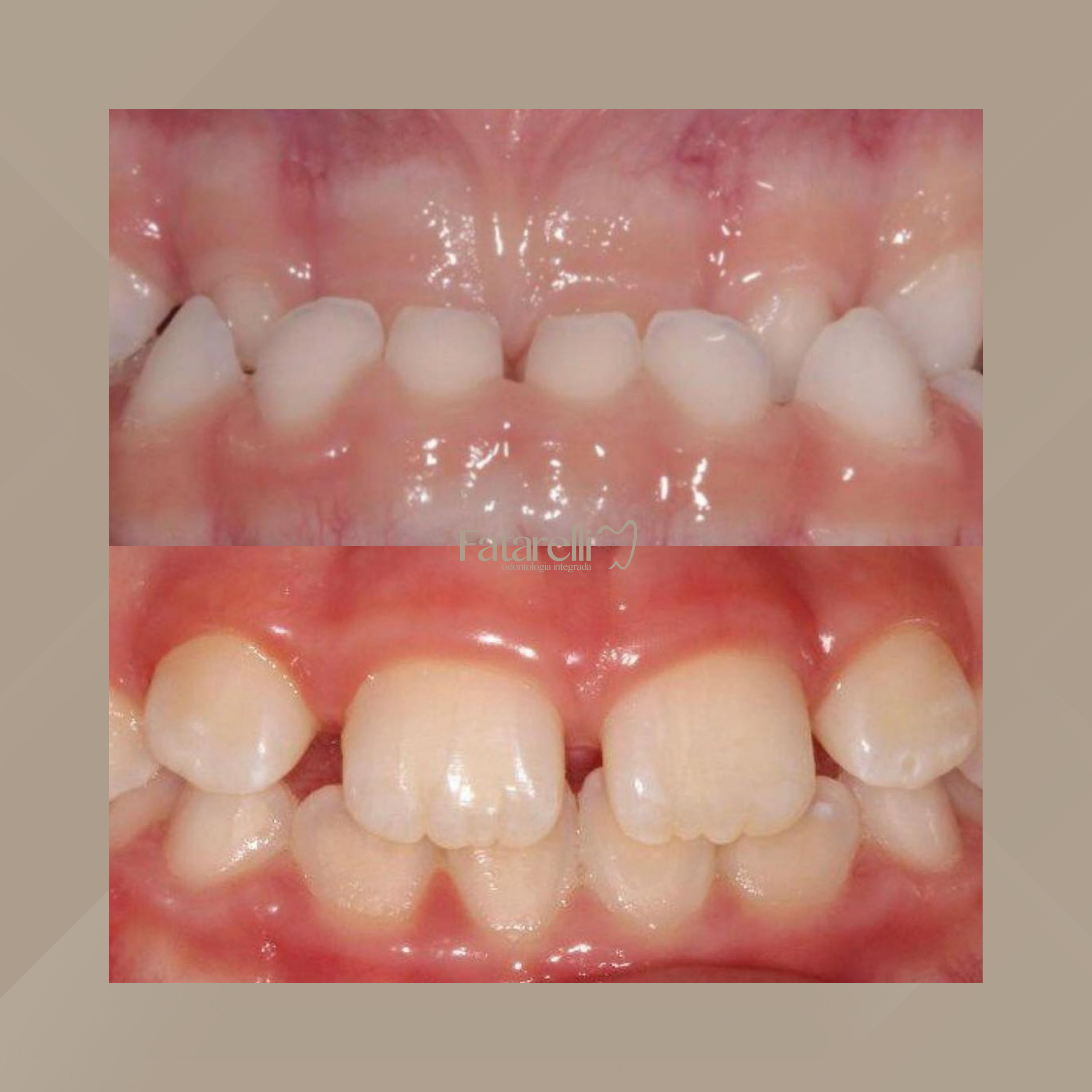 Fatarelli Odontologia Integrada. Odontopediatria #2.1