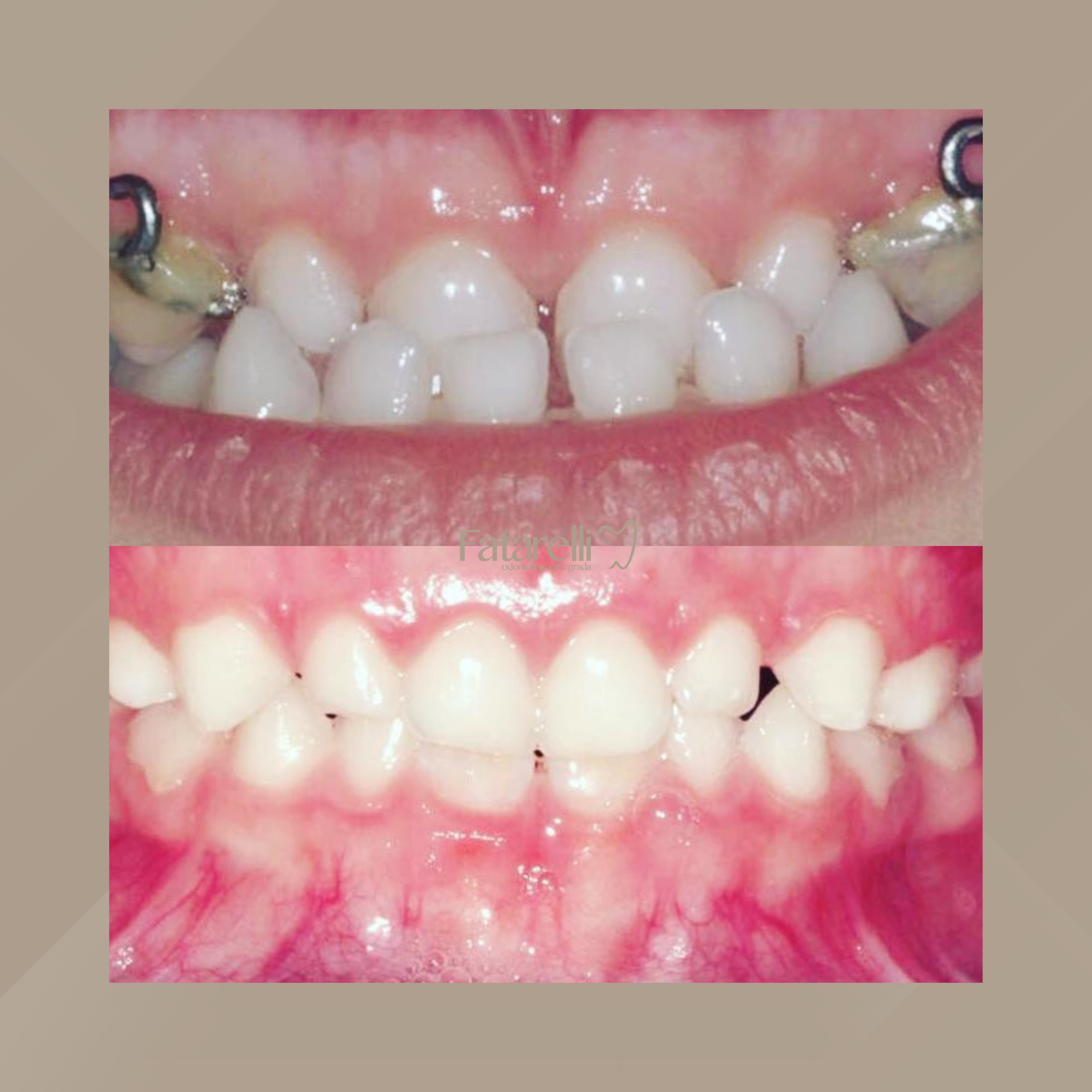 Fatarelli Odontologia Integrada. Odontopediatria #3.1