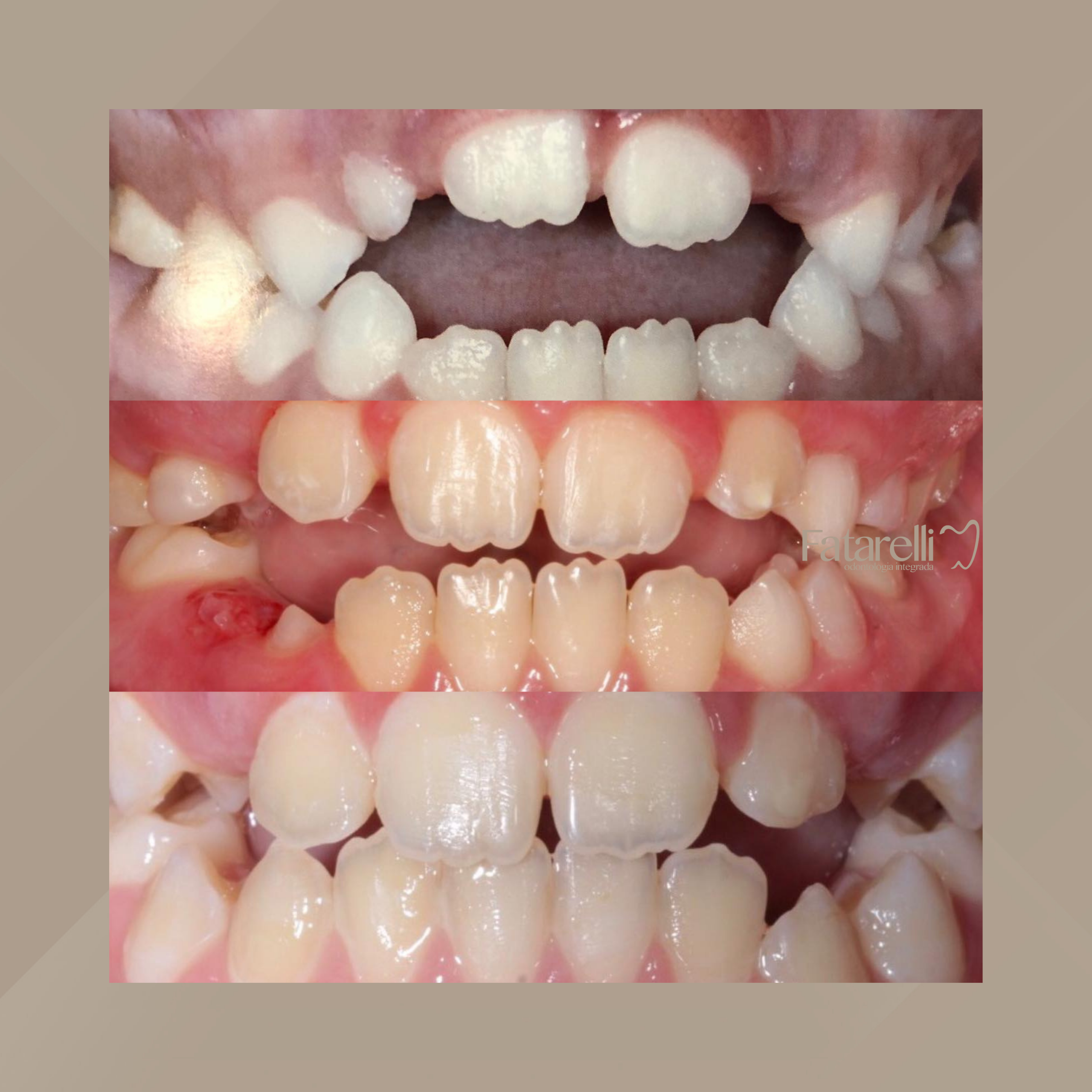 Fatarelli Odontologia Integrada. Odontopediatria #4.1